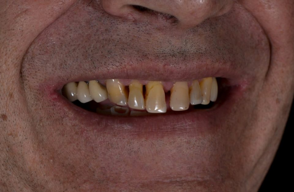 Sonrisa antes del tratamiento