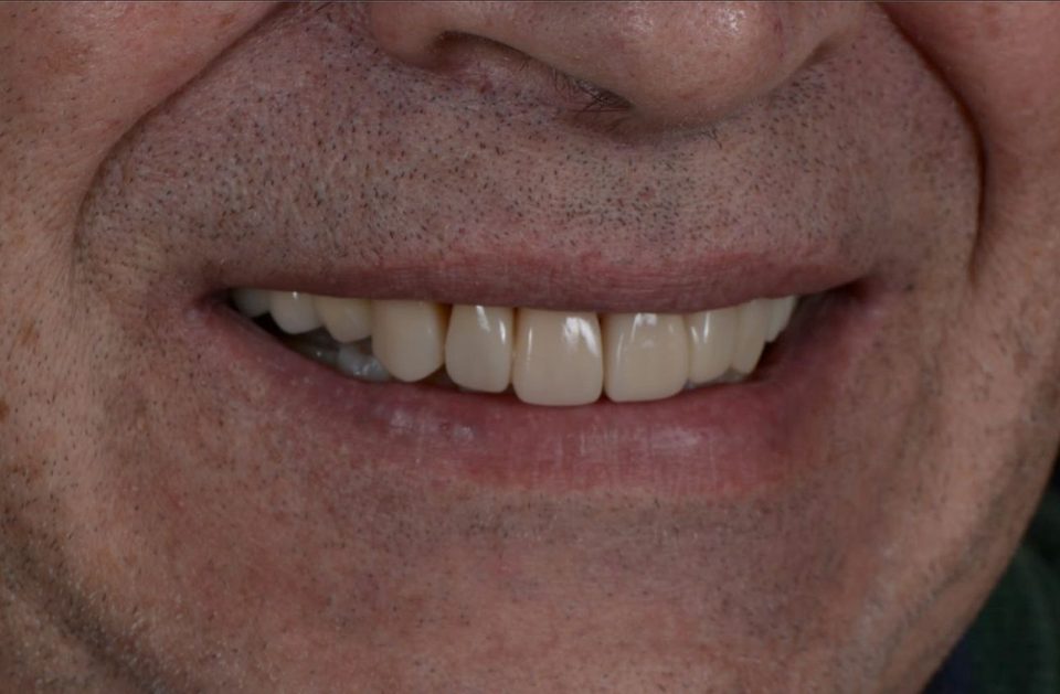 Sonrisa después del tratamiento biomimético